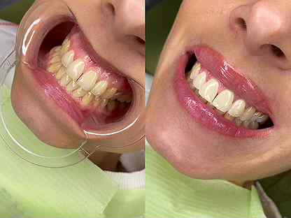 Фотоотбеливание зубов Томск Яркая томск детская стоматология на ленина