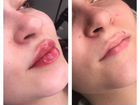 Увеличение губ. Контурная пластика губ