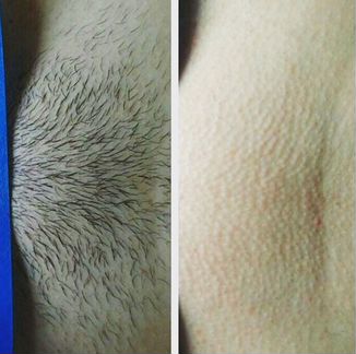 Шугаринг/Воск